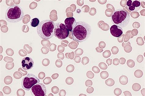 New Genetic Test Predicts Risk Of Leukemia Relapse University Of Toronto