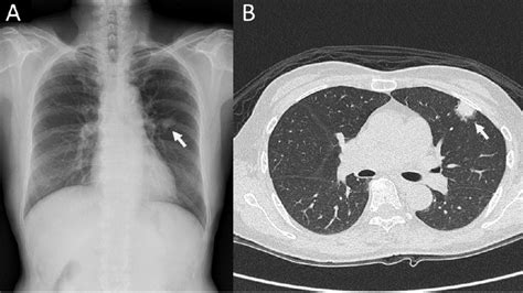 A The Chest X Ray Film Showed A Left Upper Lung Solitary Pulmonary