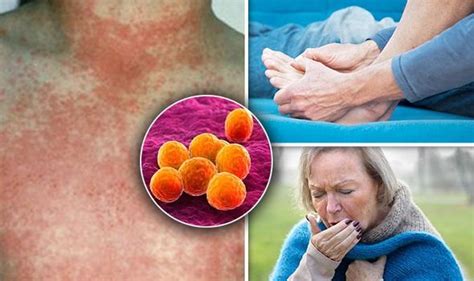 Scarlet Fever Gout And Whooping Cough In Uk Rise Symptoms Of
