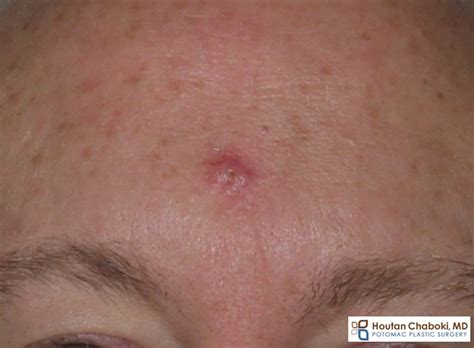 Skin Cancer Growth On Face
