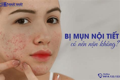 Bị Mụn Nội Tiết Có Nên Nặn Không