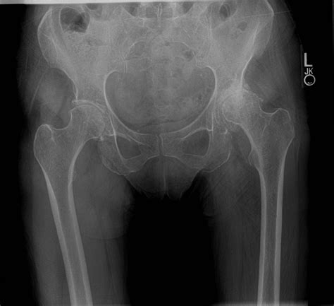 Preop Ap Pelvis Female Osteoarthritis