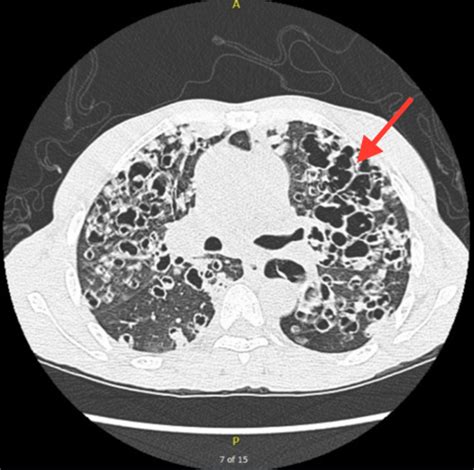 Cureus Recurrent Pneumocystis Pneumonia With Uncommon Radiographic