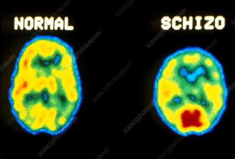 Schizophrenia Brain Vs Normal Brain