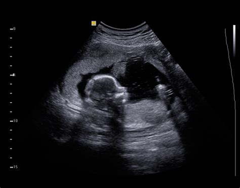 6 Month Pregnancy Ultrasound