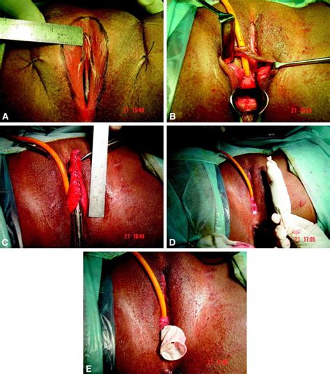 Horse Shoe Flap Vaginoplasty—a New Technique Of Vaginal