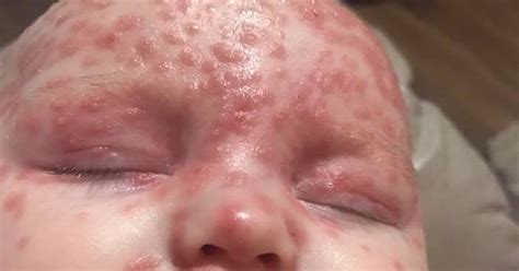 Mum Issues Warning After Six Month Old Baby Contracts Herpes Despite