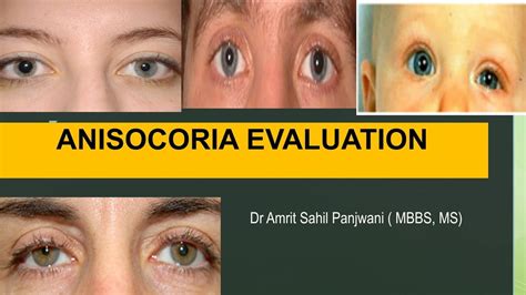 Anisocoria Evaluation Unequal Pupil Sizes Youtube
