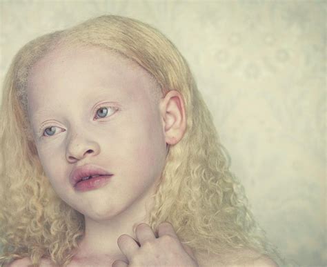 Rare Albino Humans