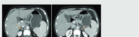 Abdominal Ct Scan Showing Bilateral Enlargement Of The Adrenal Glands
