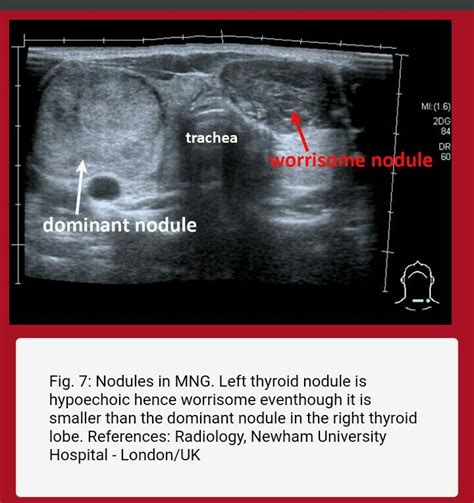 Pin By Dr Abuaiad On Superficial Diagnostic Medical Sonography