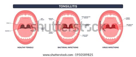 Tonsil Stones Crypts Viral Virus Gland Stock Vector Royalty Free