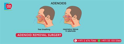 Adenoidectomy Treatment Ent Doctor Abu Dhabi Aesmc