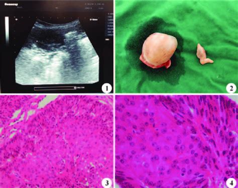 Testis Mixed Germ Cell Sex Cord Stromal Tumour Trans Abdominal Download Scientific Diagram