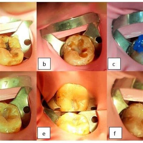 Pdf 4 6 Case Report Direct Composite Restoration Using Stamp