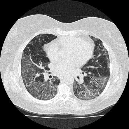 Desquamative Interstitial Pneumonia Radiology Reference Article Radiopaedia Org
