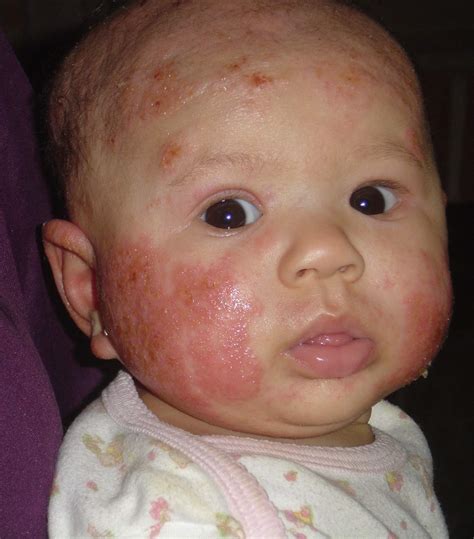 What Aggravates Eczema In Babies Get More Anythinks
