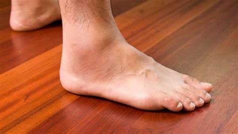 Swelling Of Ankles And Legs Can Be A Serious Problem