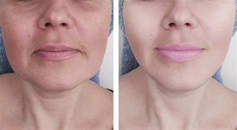 Woman Wrinkles Before And After Procedures Anti Age Naturally