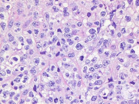 Primary Mediastinal B Cell Lymphoma