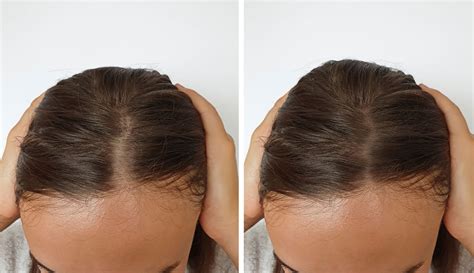 Alopecia Hair Loss Ny Hudson Dermatology