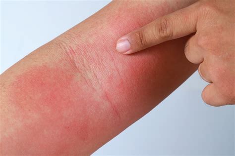 How To Find Relief From Eczema When Sunburn Aggravates It