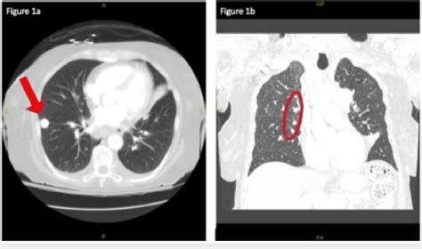 Ct Chest With Contrast A Right Sided Coin Lesion Shown By The Red