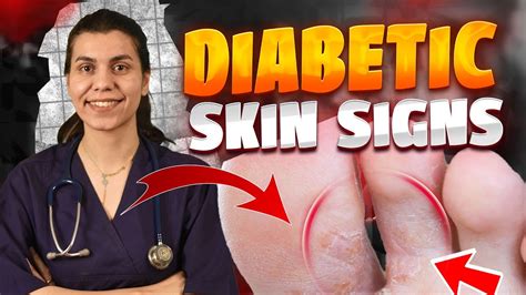 Diabetic Skin Problems And Top Signs Of Diabetes On The Skin Youtube