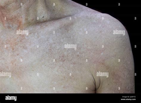 Age Spots And White Patches On Chest Of Asian Elder Man Age Soots Are