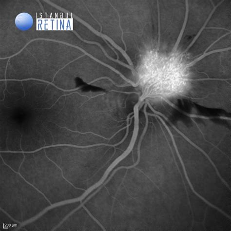 57 Exophytic Juxtapapillary Retinal Capillary Hemangioma Oct Club