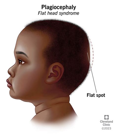 Plagiocephaly Positional Plagiocephaly Flat Head Syndrome Causes
