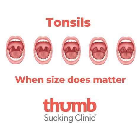 Tonsils When Size Does Matter Many People Including Health