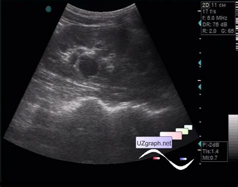 Urinary Tract Sonography Renal Sinus Cyst Plus Clinical Report