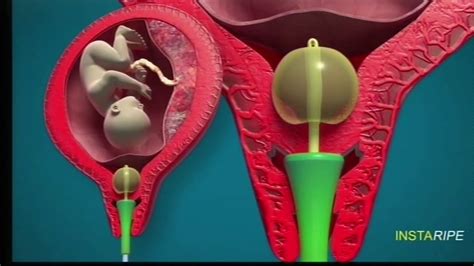 Drpanickers Rapid Cervical Ripening Device Instaripe For Induction