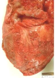 Inflammation is your body's response to infection or injury. Inflammatory Heart Disease at Ross University School of ...