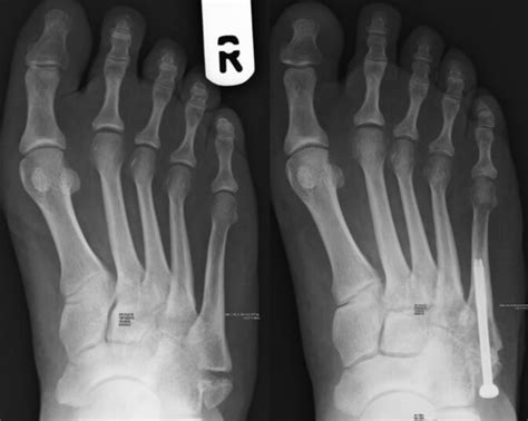 5th Metatarsal Fracture