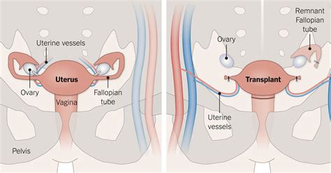 Uterus Transplants May Soon Help Some Infertile Women In The Us Become Pregnant The New York