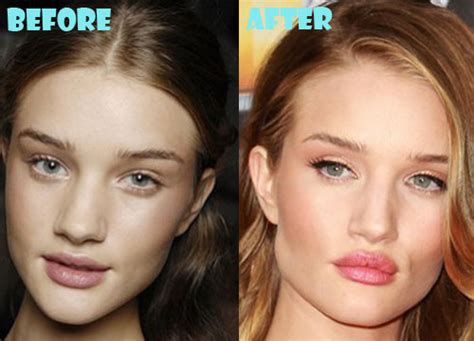 Rosie Huntington Whiteley Plastic Surgery Before After Lovely Surgery
