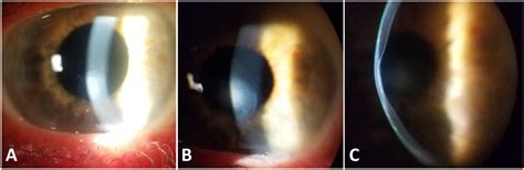 Posterior Keratoconus American Academy Of Ophthalmology