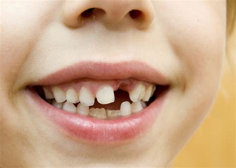 Cavities Healthy Ideas For Kids