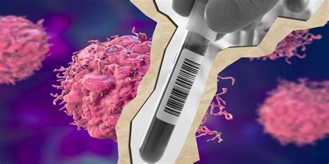 Cancer un simple test sanguin et urinaire pourrait détecter plusieurs tumeurs Marie Claire