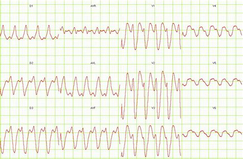 Ventricular Tachycardia Diagnosis Wikidoc