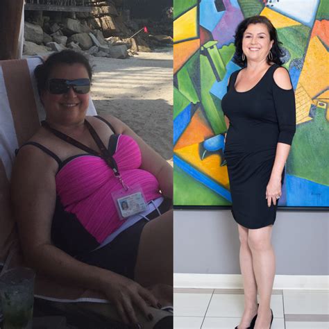 Weight Loss Surgery Before And After Photos Soma Bariatrics Los Angeles