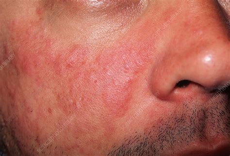 Lupus Skin Rash Stock Image M2000168 Science Photo Library