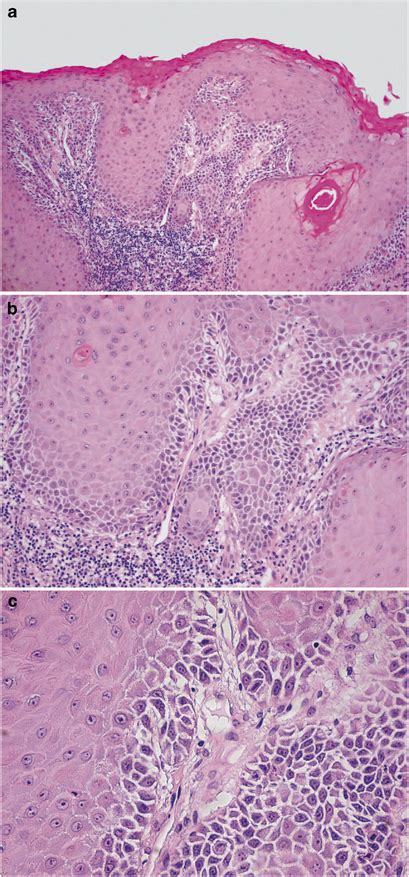 Overview Of Differentiated Vulvar Intraepithelial Neoplasia With