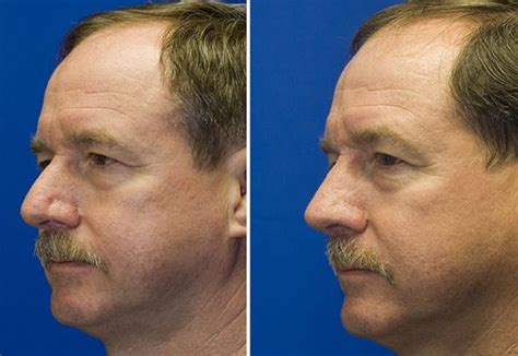 male rhinoplasty surgery dr arash moradzadeh plastic surgery rhinoplasty surgery male nose