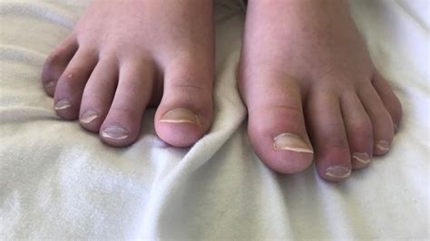 Covid In Scotland Covid Toes Has Left Me Unable To Wear Shoes Bbc News