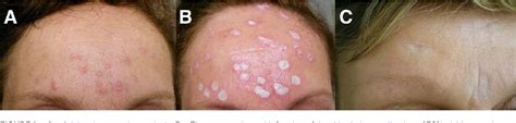 70 Trichloroacetic Acid In The Treatment Of Facial Sebaceous