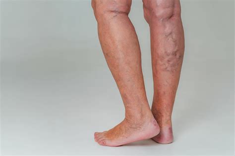 What Are Reticular Veins The Vein Company