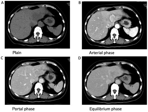 Preoperative Abdominal Ct Of The Liver Tumor A Ct Demonstrated A